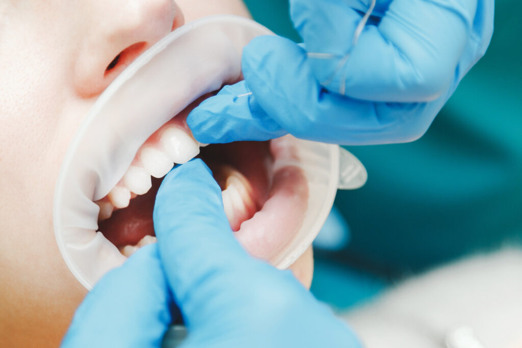 Keys to Cavity Prevention