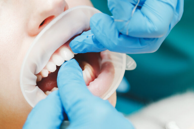 Keys to Cavity Prevention