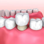How Long Do Dental Crowns Last