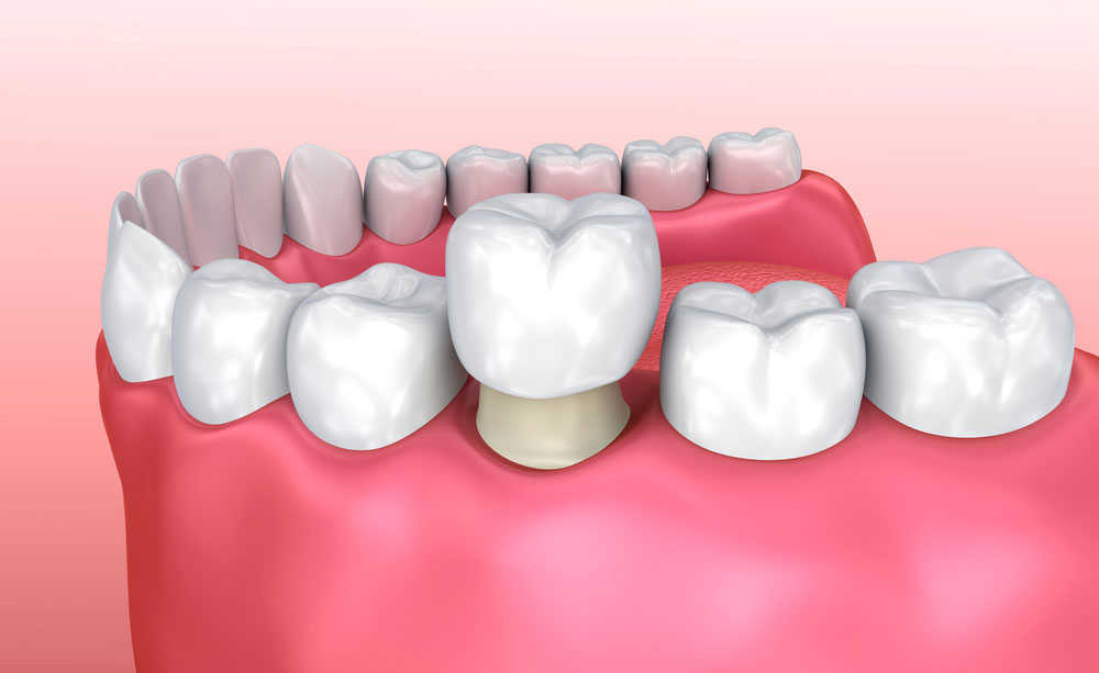 How Long Do Dental Crowns Last