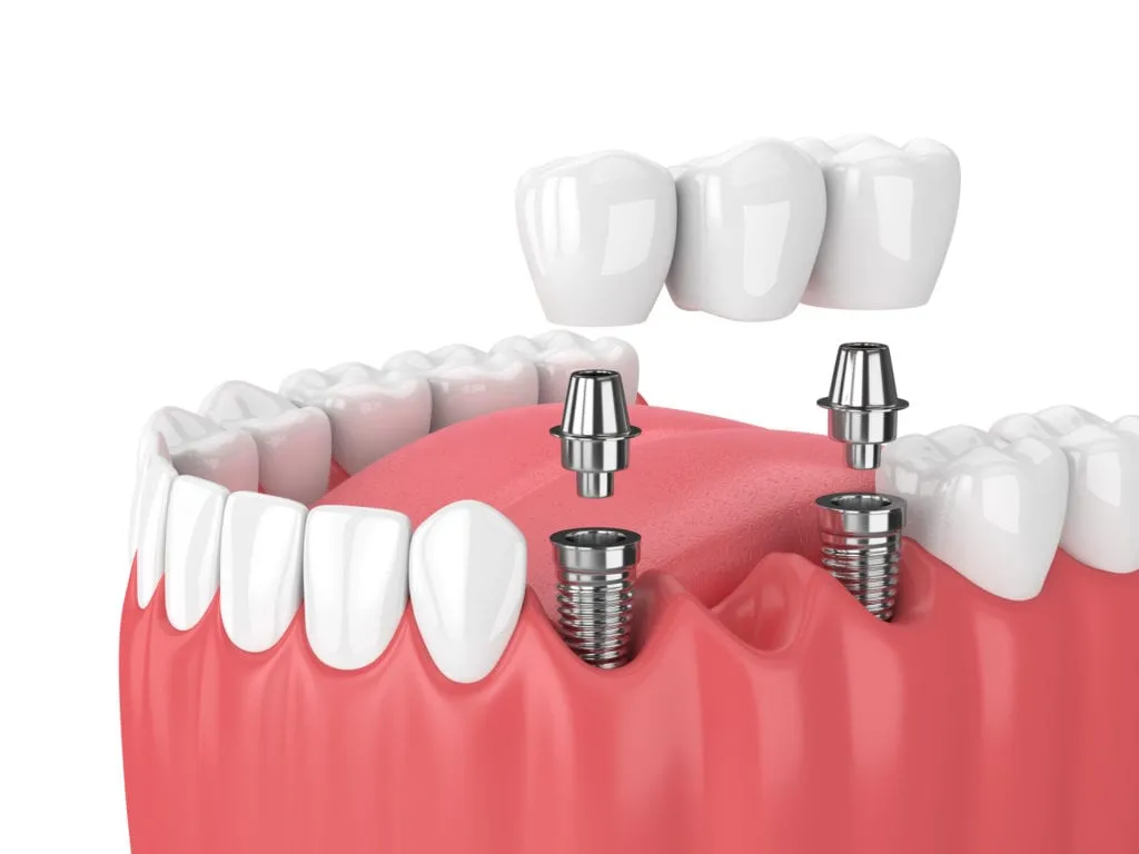 Tips for Choosing the Best Dental Implant Clinic in Chicago Tips for Choosing the Best Dental Implant Clinic in Chicago