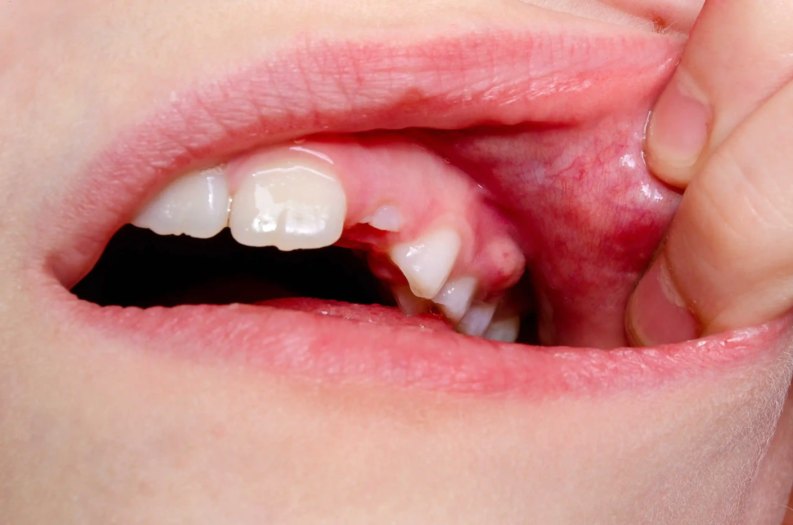 Advanced Gum Disease Treatment Options at East Erie Dental Advanced Gum Disease Treatment Options at East Erie Dental