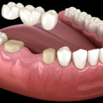 How to Know If You Need a Dental Bridge