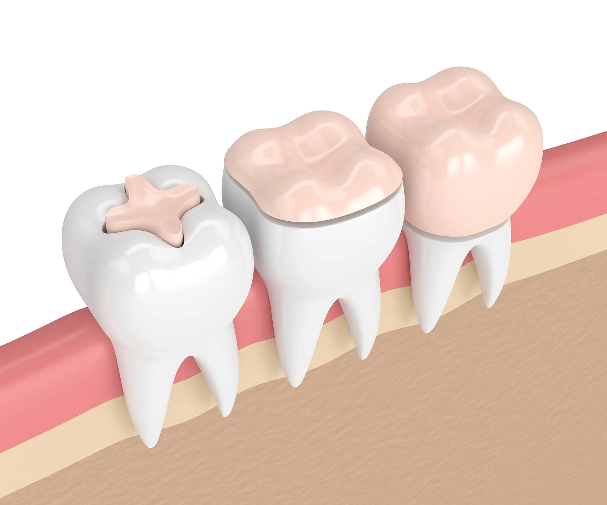 Types of Dental Crowns Available in Chicago Types of Dental Crowns Available in Chicago