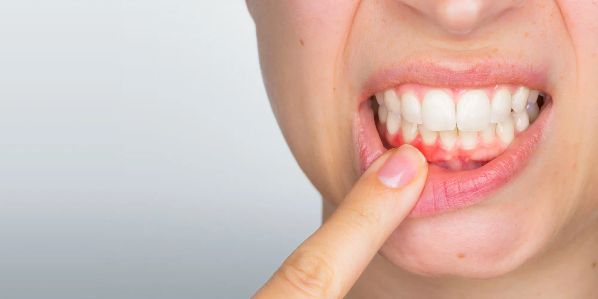 Understanding the Stages of Gum Disease Understanding the Stages of Gum Disease