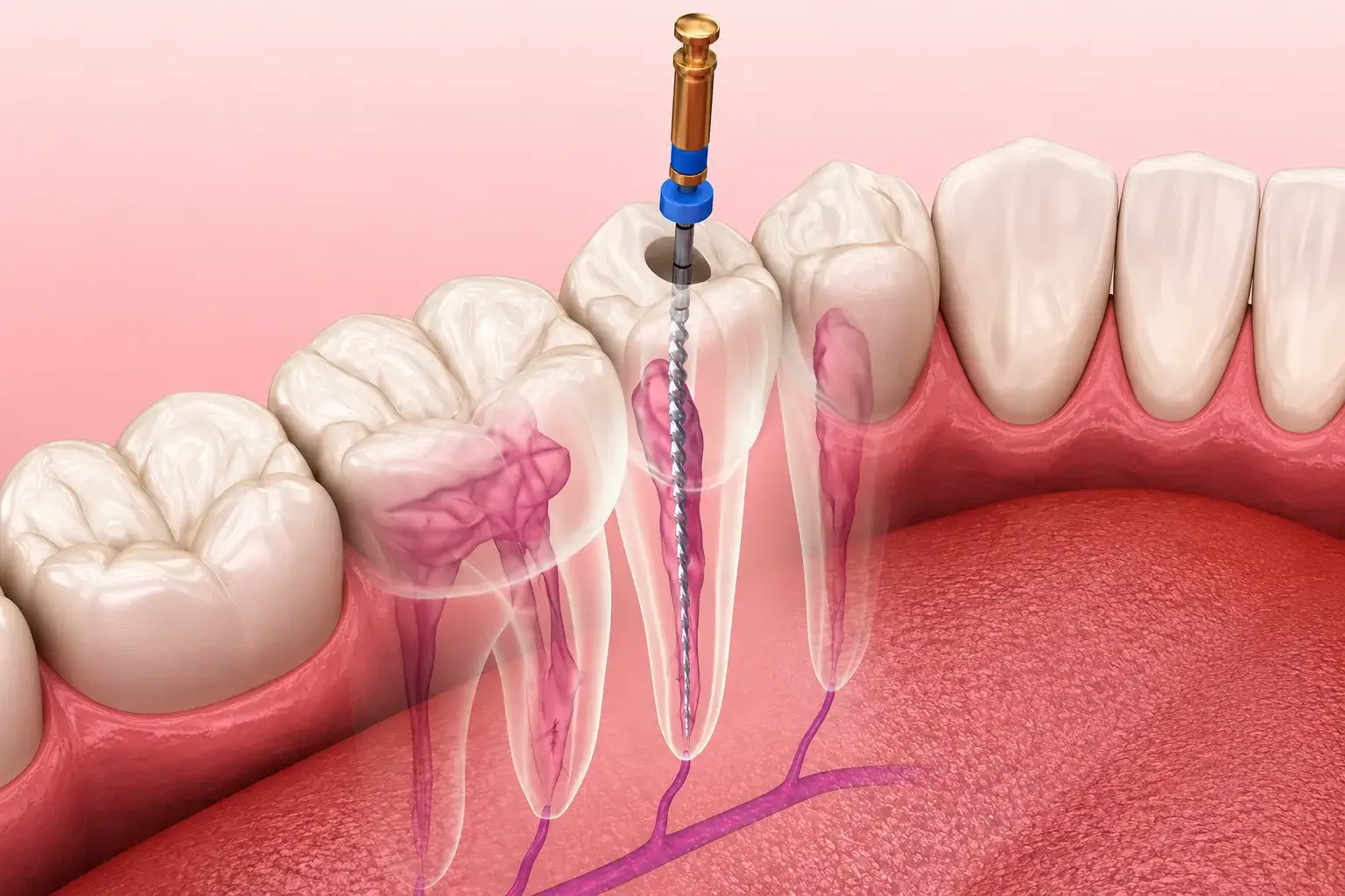 Root Canal Procedure at East Erie Dental Root Canal Procedure at East Erie Dental