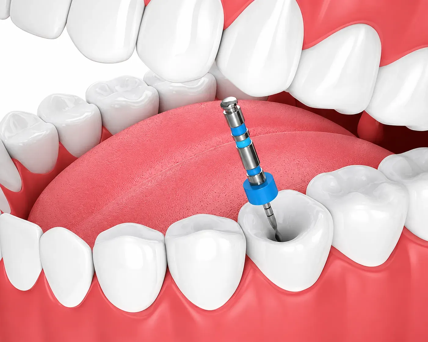 Why Do You Need a Root Canal Why Do You Need a Root Canal