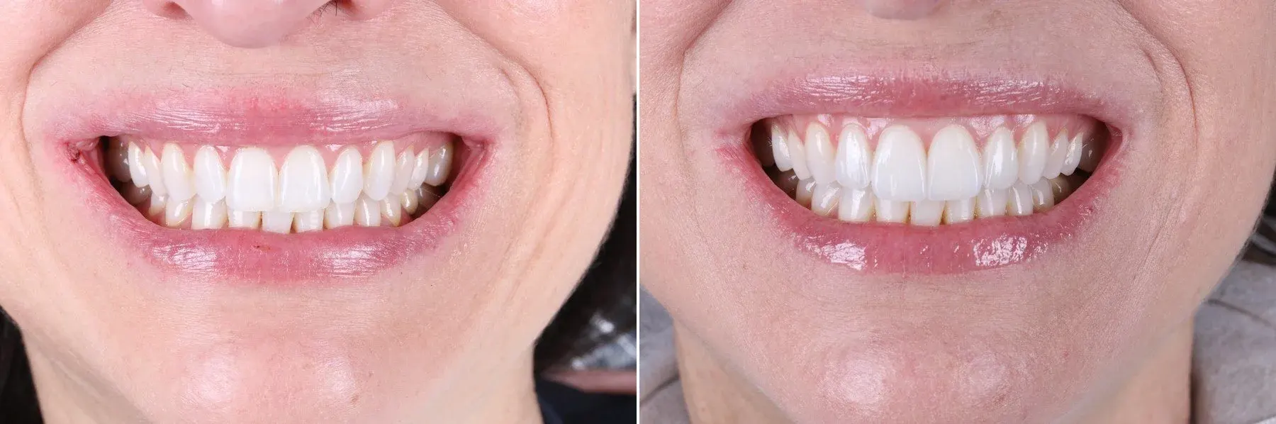 Why choose East Erie Dental for Veneers in Chicago? Why choose East Erie Dental for Veneers in Chicago?